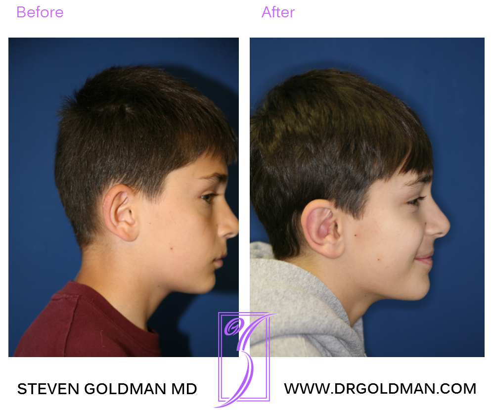 Otoplasty