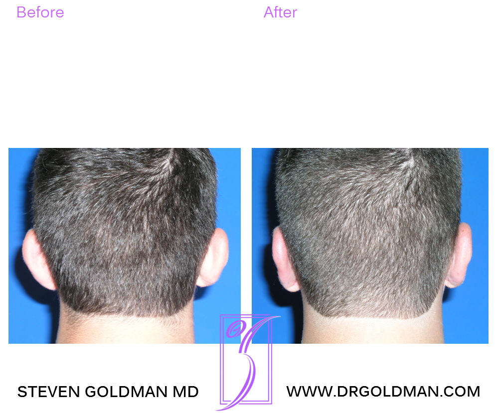 Otoplasty