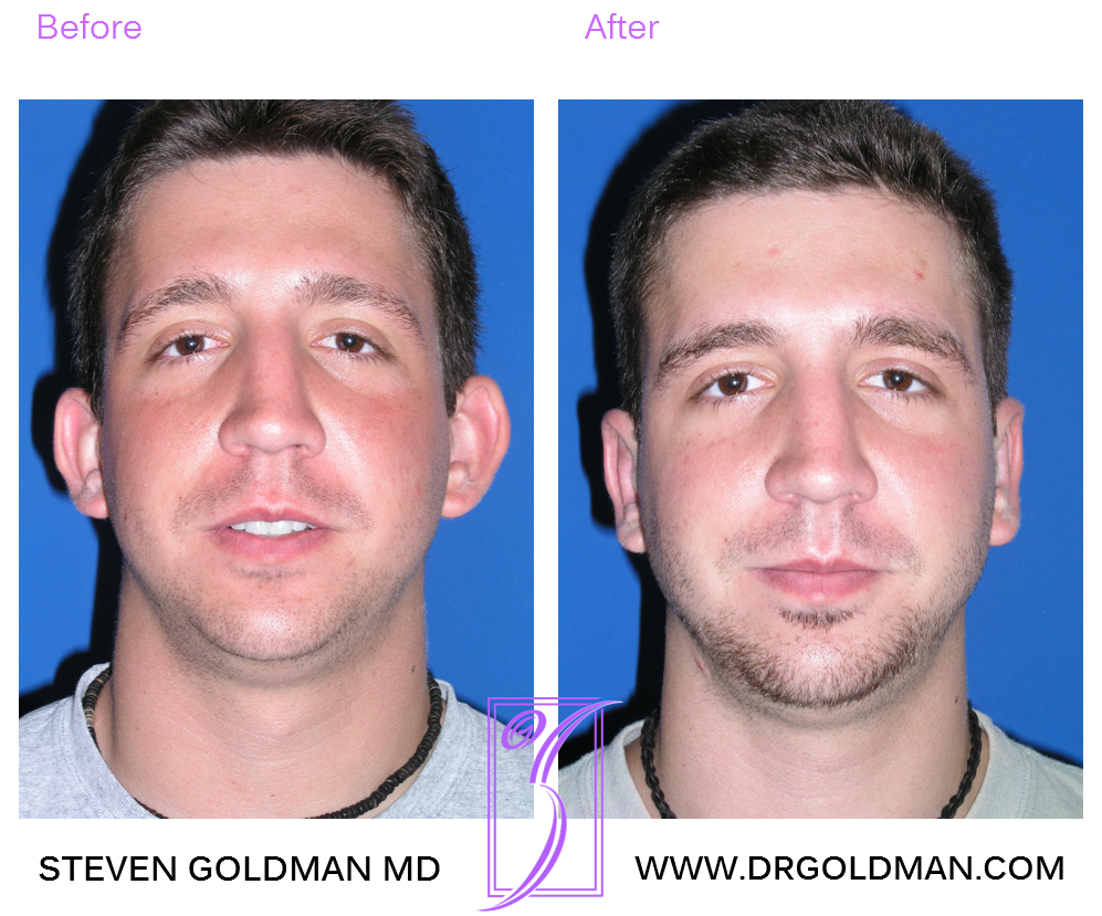 Otoplasty