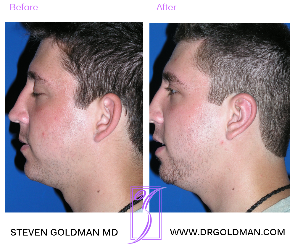 Otoplasty