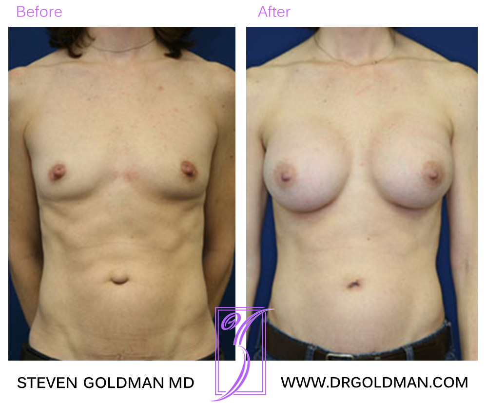 Breast Augmentation