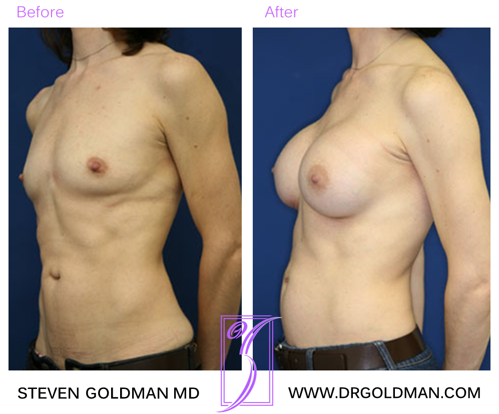 Breast Augmentation