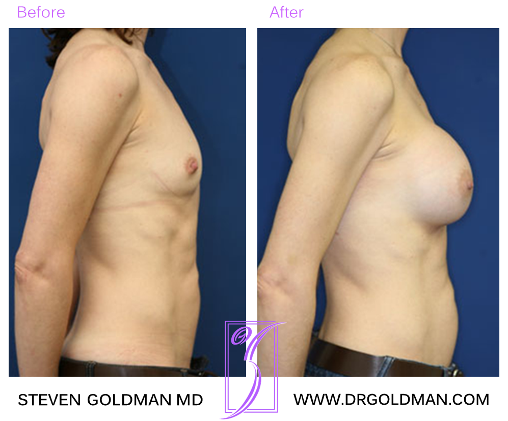 Breast Augmentation