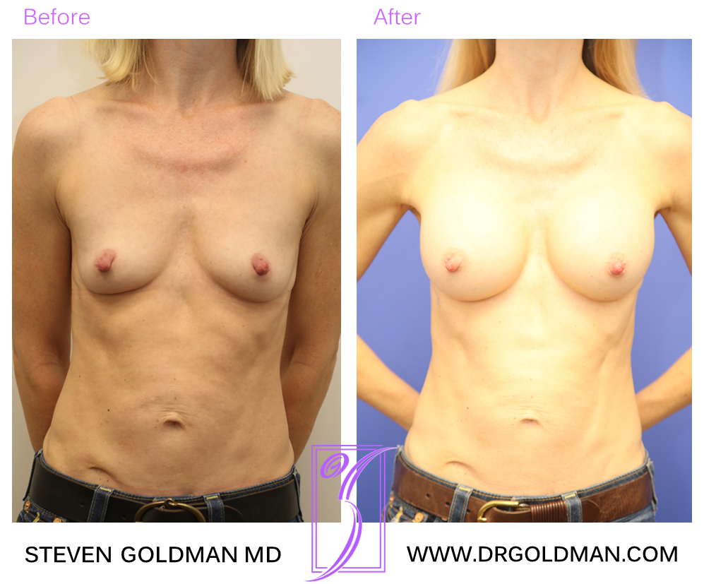 Breast Augmentation