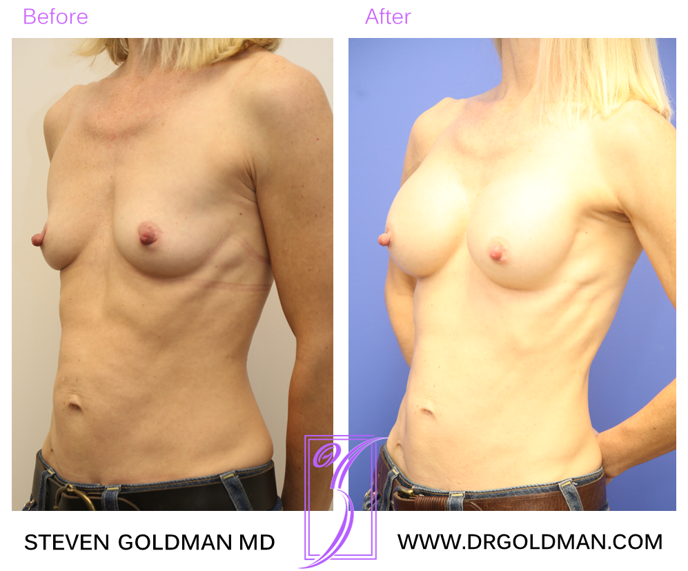 Breast Augmentation