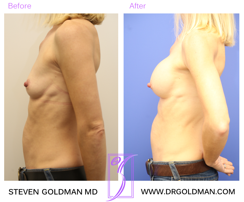 Breast Augmentation
