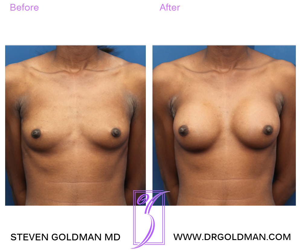 Breast Augmentation