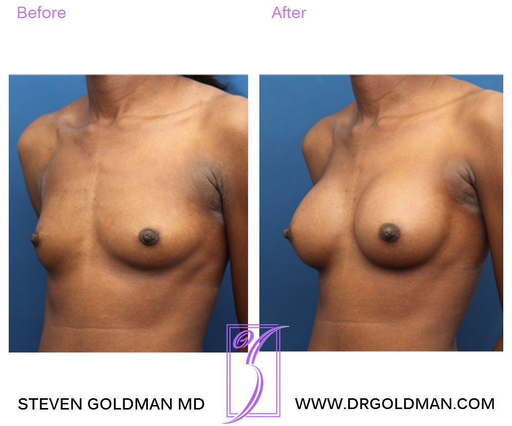 Breast Augmentation