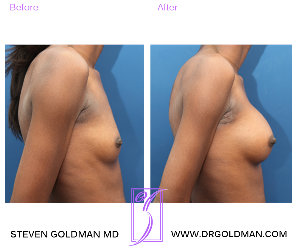 Breast Augmentation