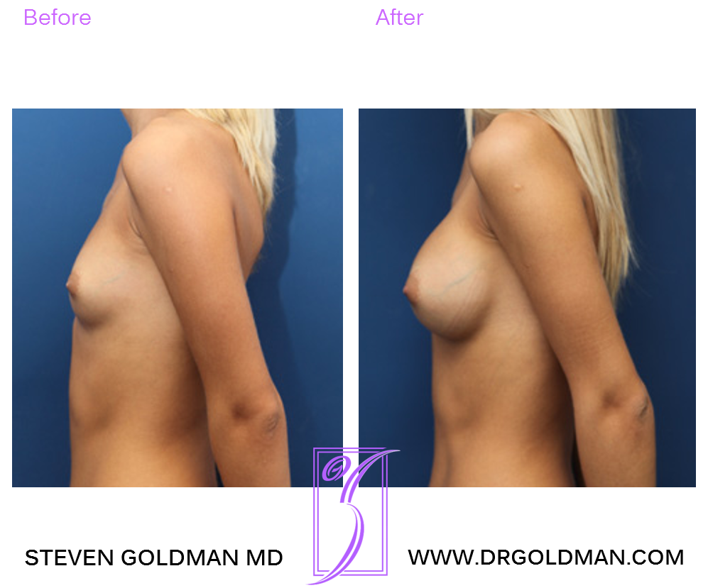 Breast Augmentation