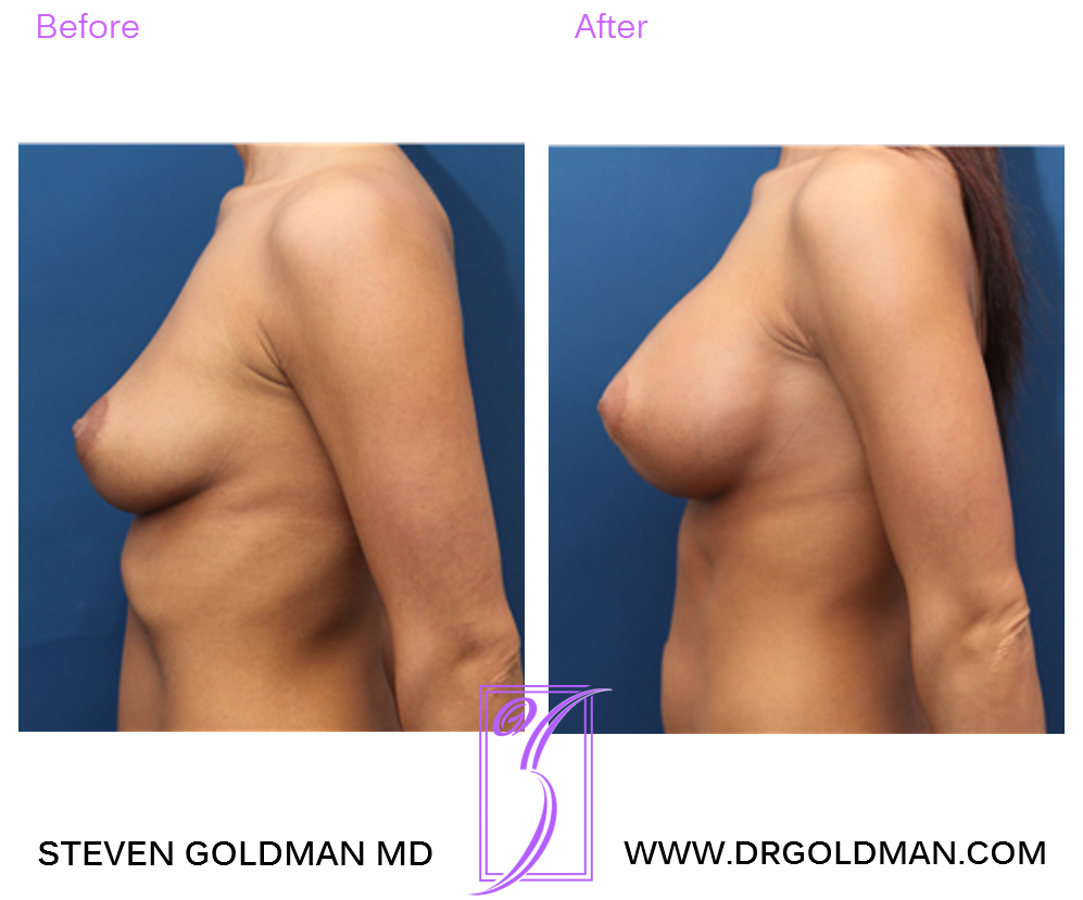 Breast Augmentation