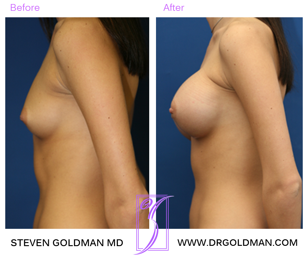 Breast Augmentation