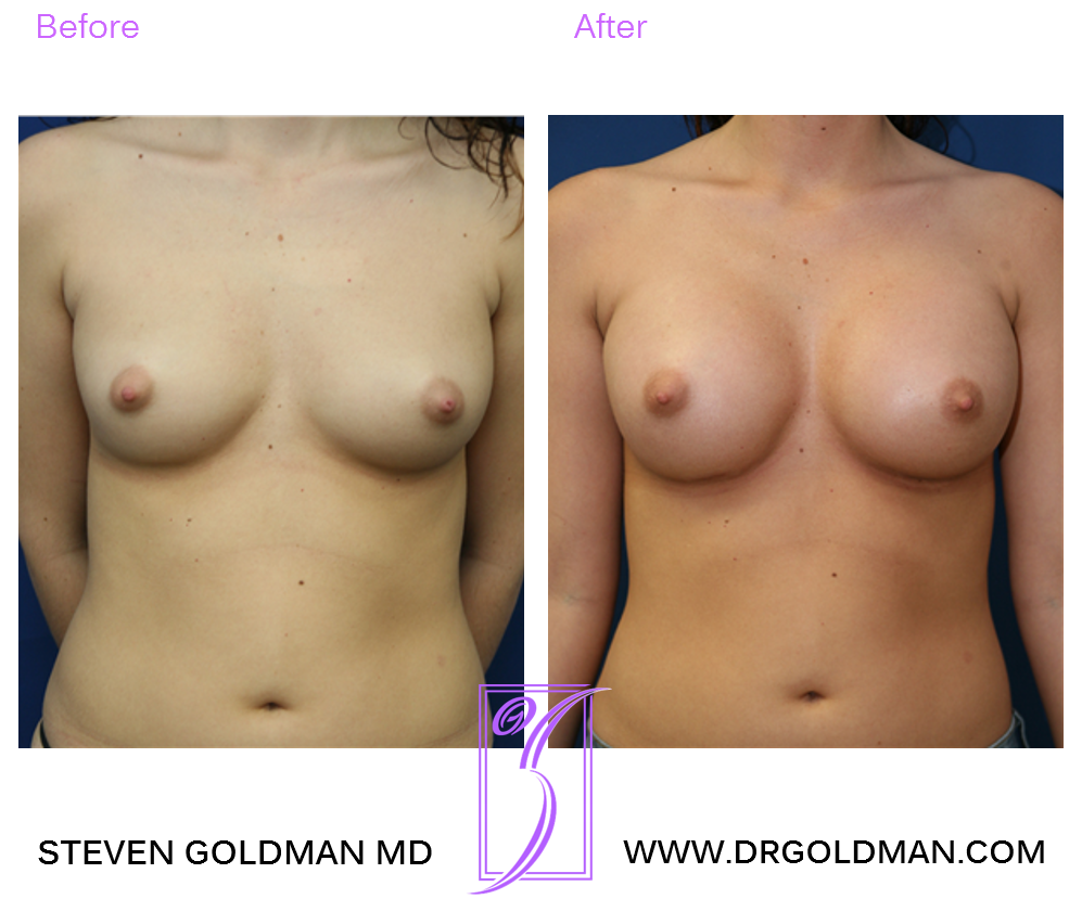 Breast Augmentation