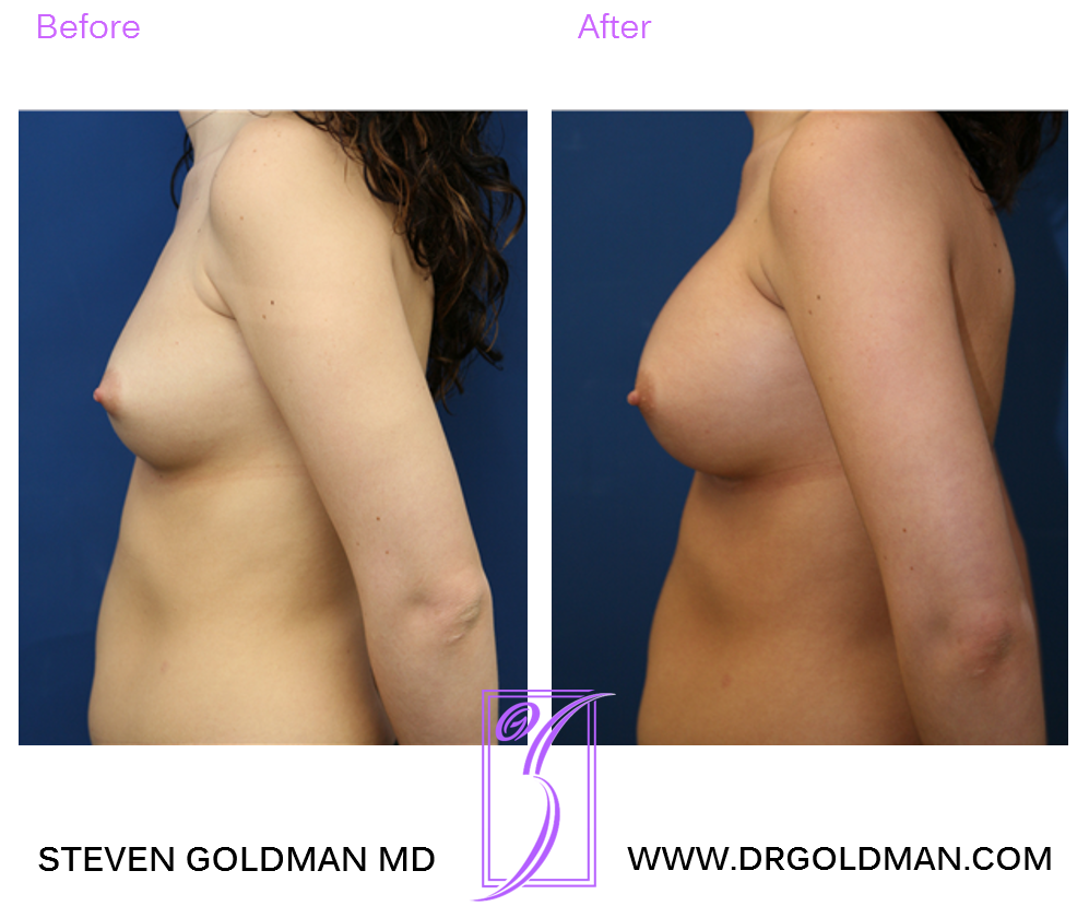 Breast Augmentation