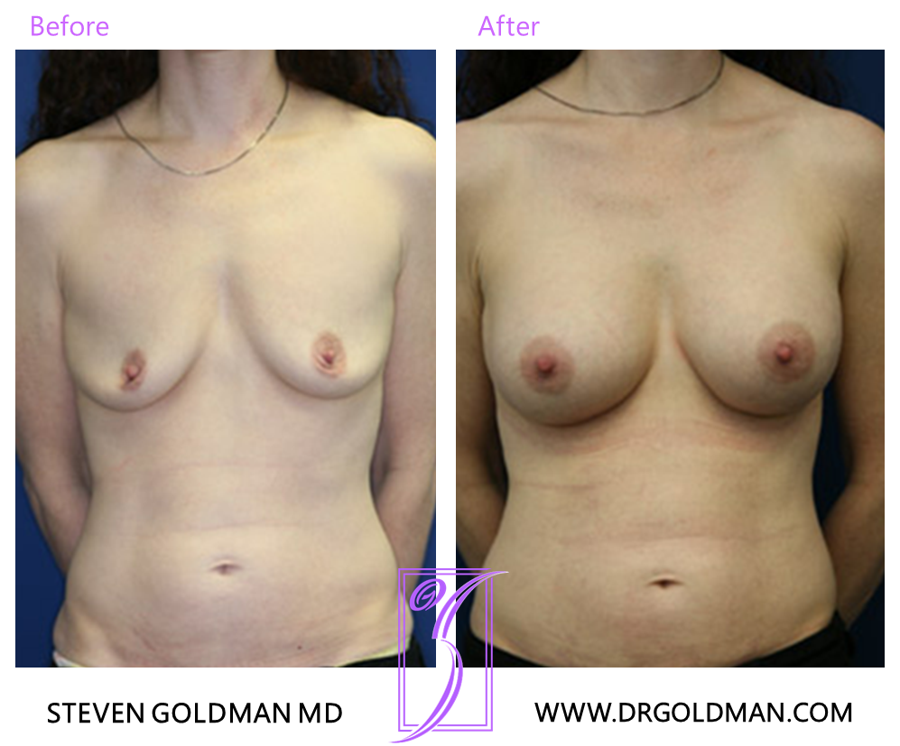 Breast Augmentation