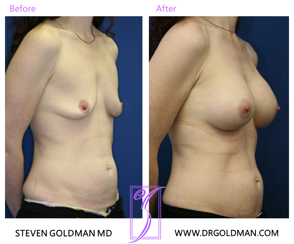 Breast Augmentation