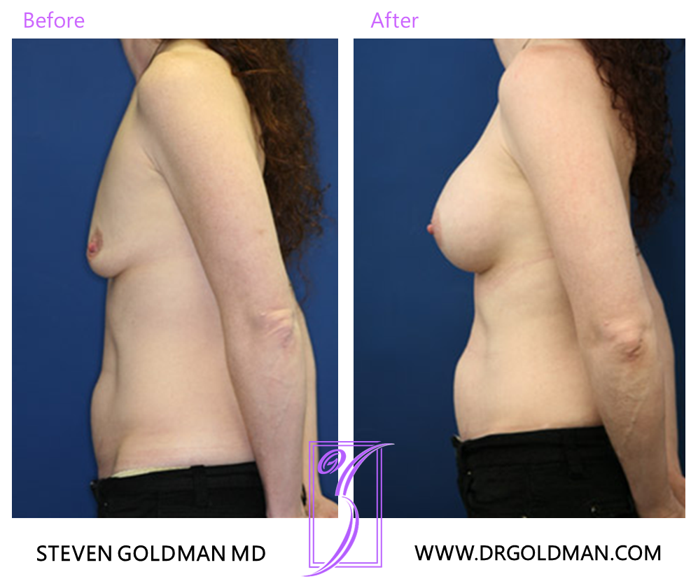 Breast Augmentation