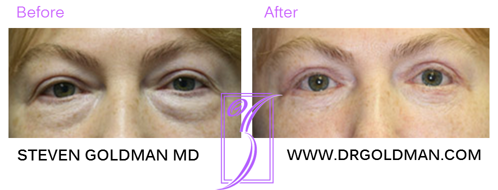 Blepharoplasty