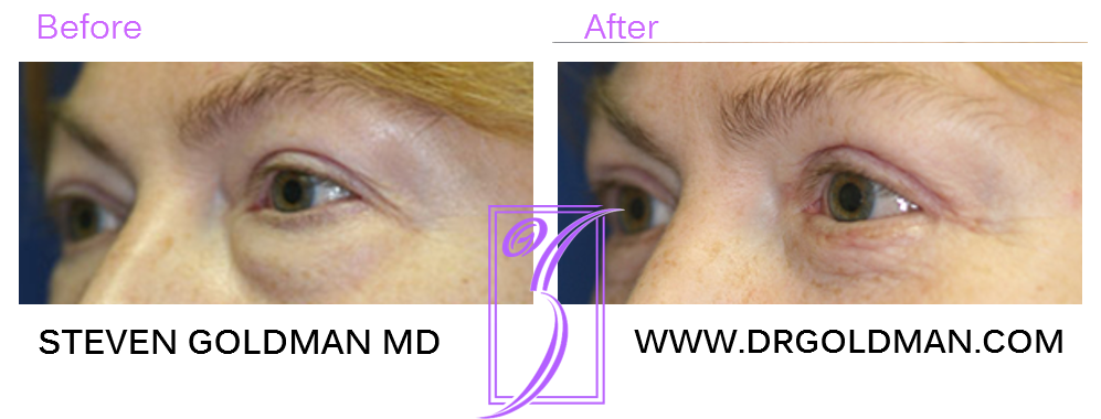 Blepharoplasty