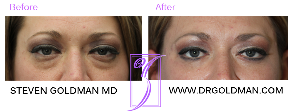 Blepharoplasty