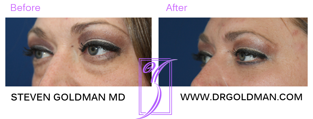 Blepharoplasty