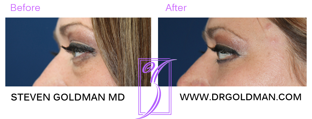 Blepharoplasty