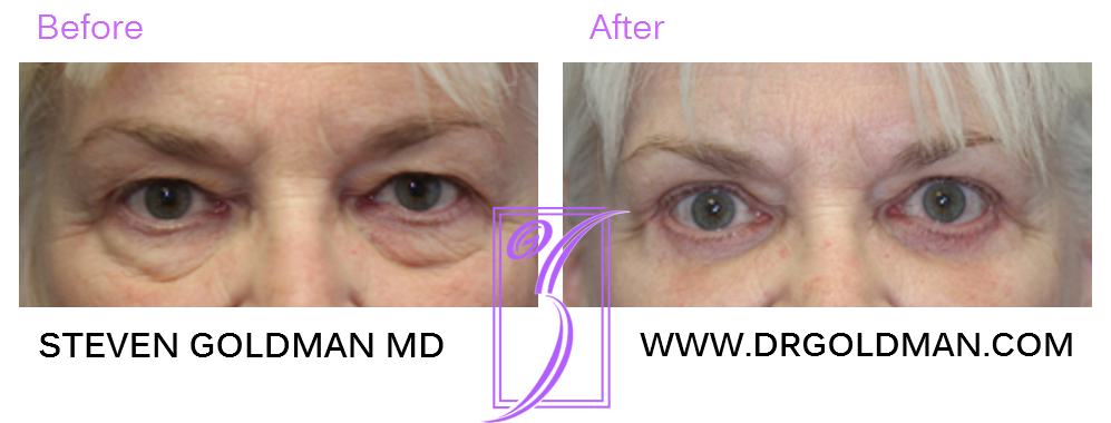Blepharoplasty