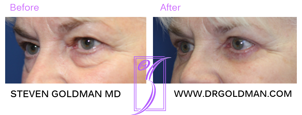 Blepharoplasty