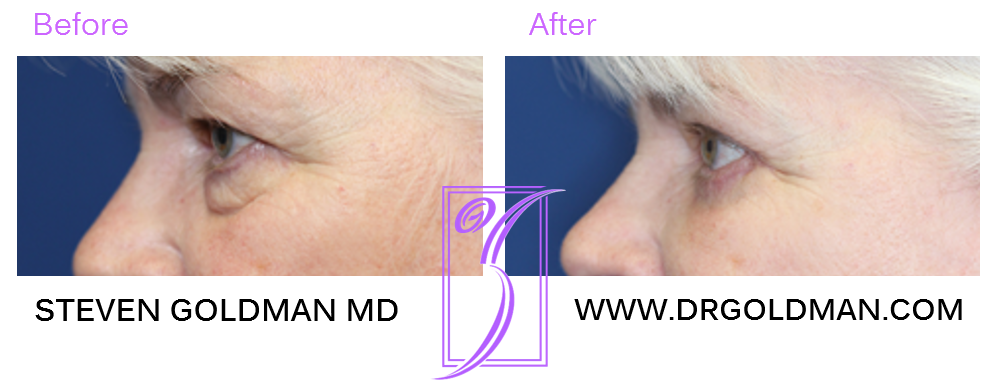 Blepharoplasty