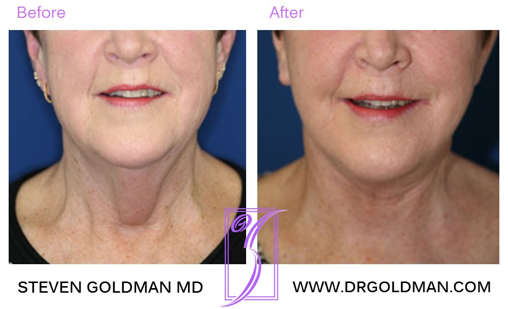 Facelift
