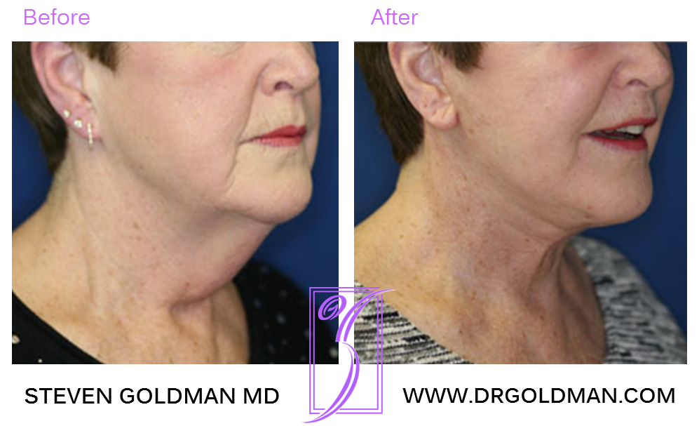 Facelift