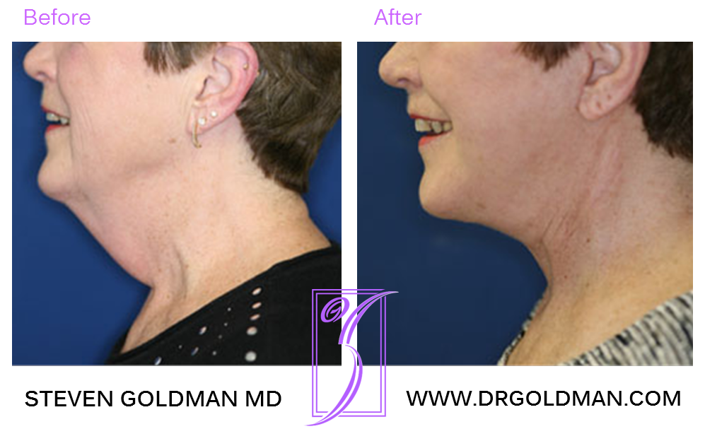 Facelift