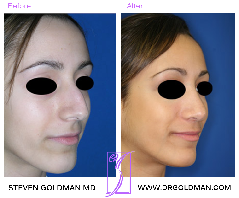 Rhinoplasty