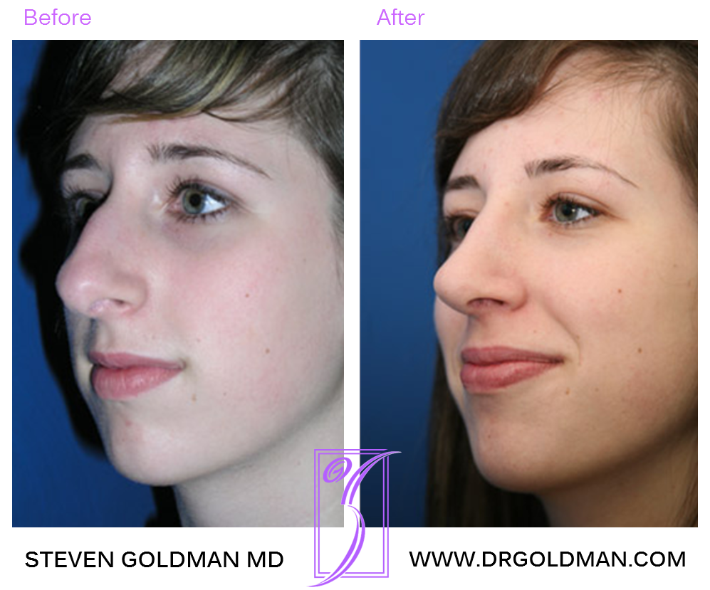 Rhinoplasty