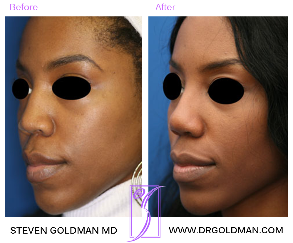 Rhinoplasty