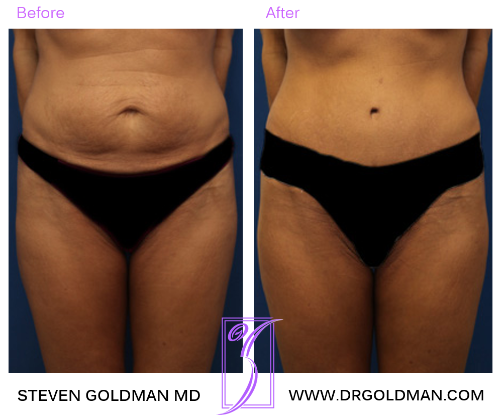 Abdominoplasty