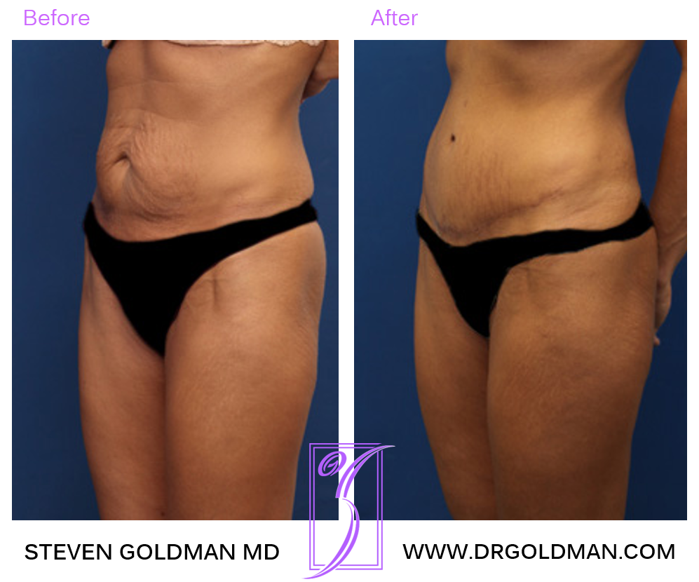 Abdominoplasty