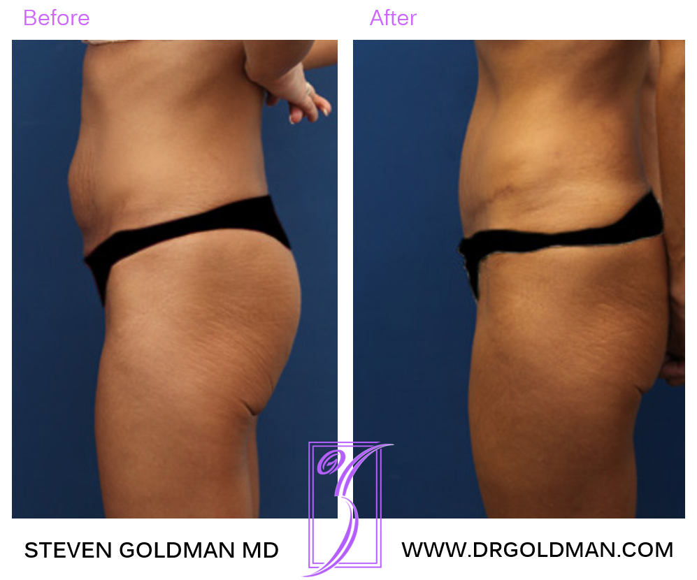 Abdominoplasty