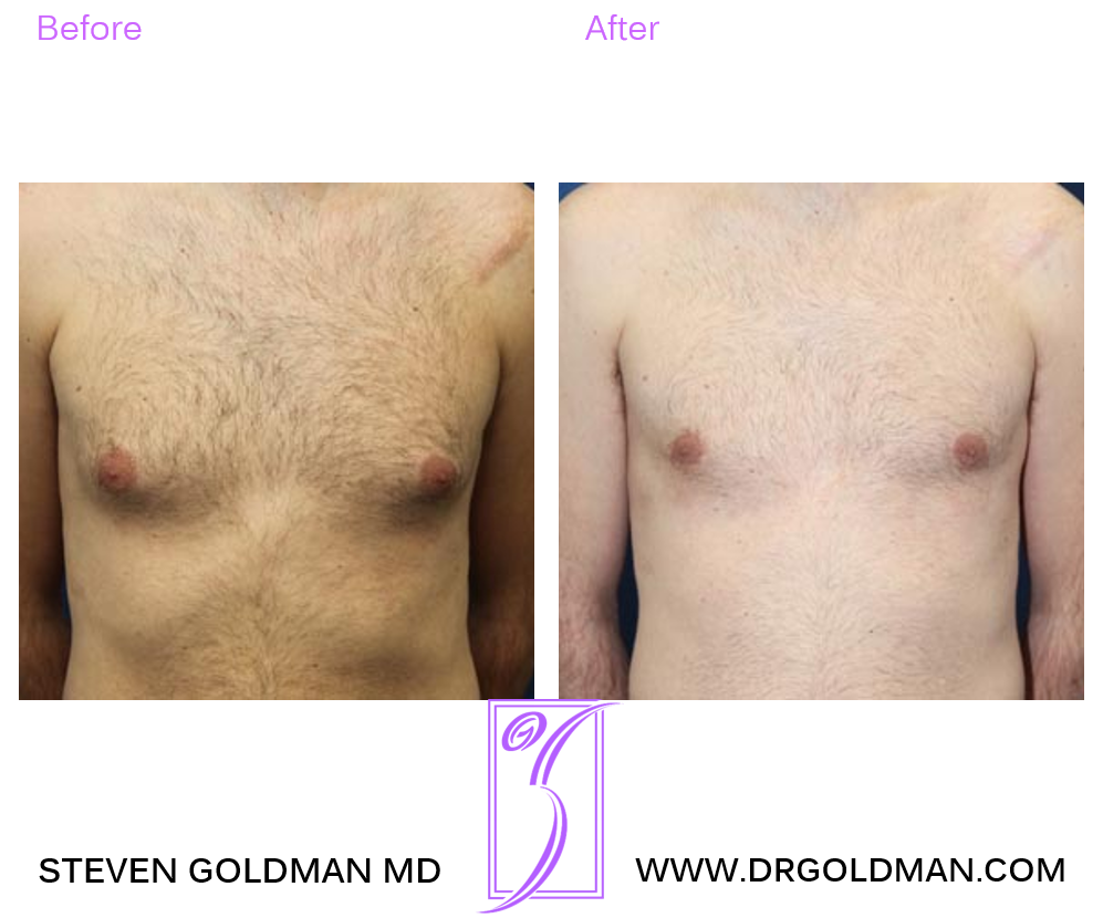 Gynecomastia