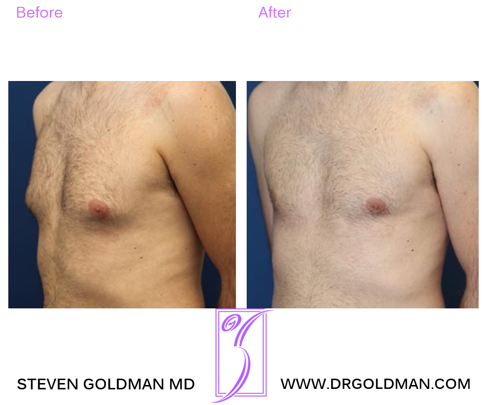 Gynecomastia