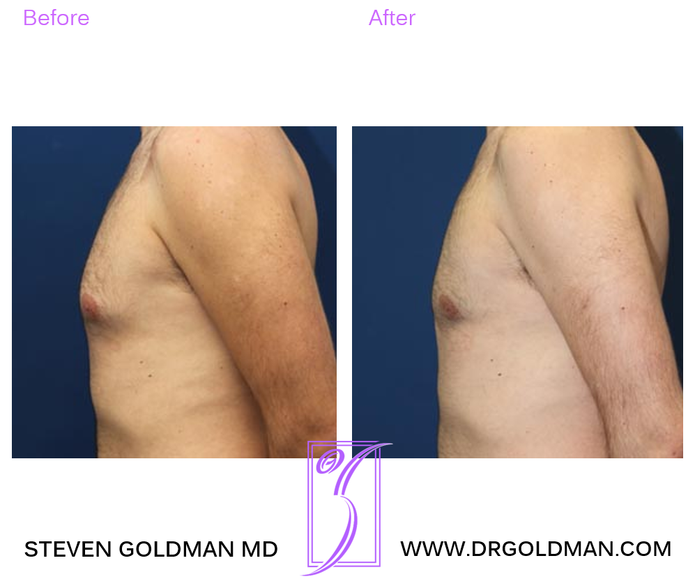 Gynecomastia