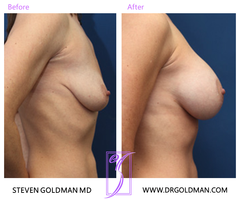 Breast Lift