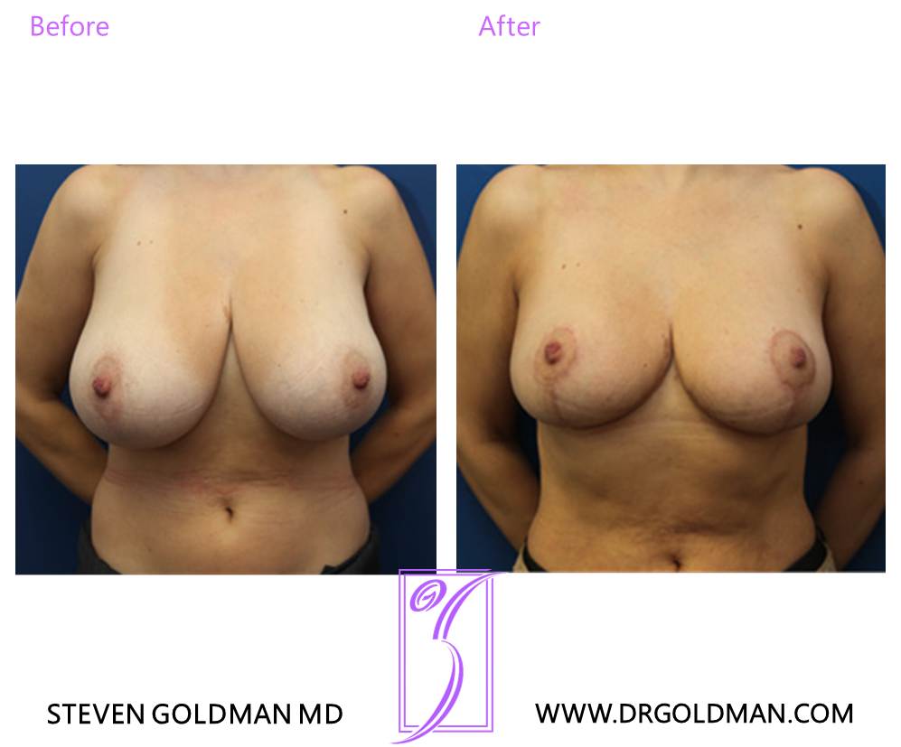 Breast Reduction