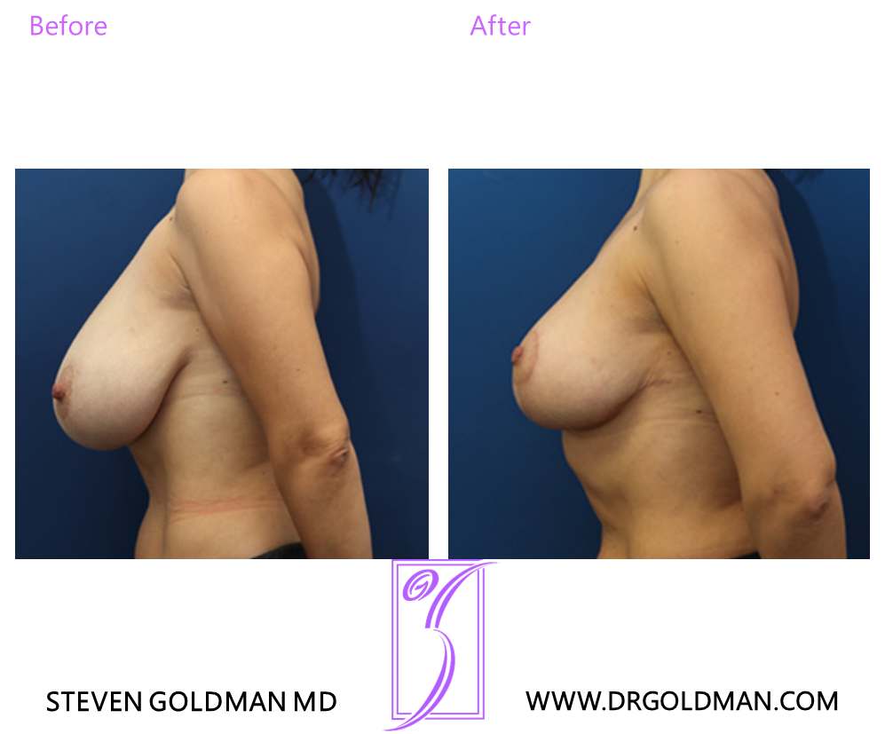 Breast Reduction
