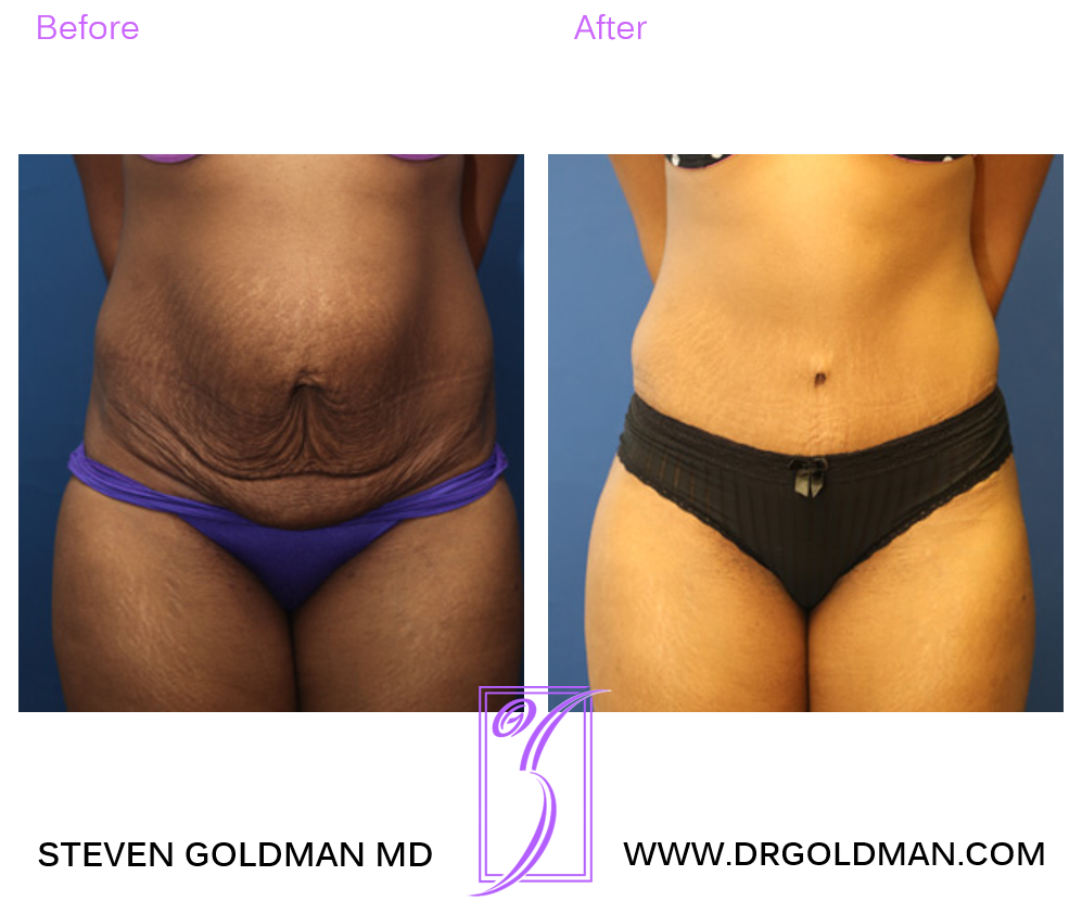 Abdominoplasty