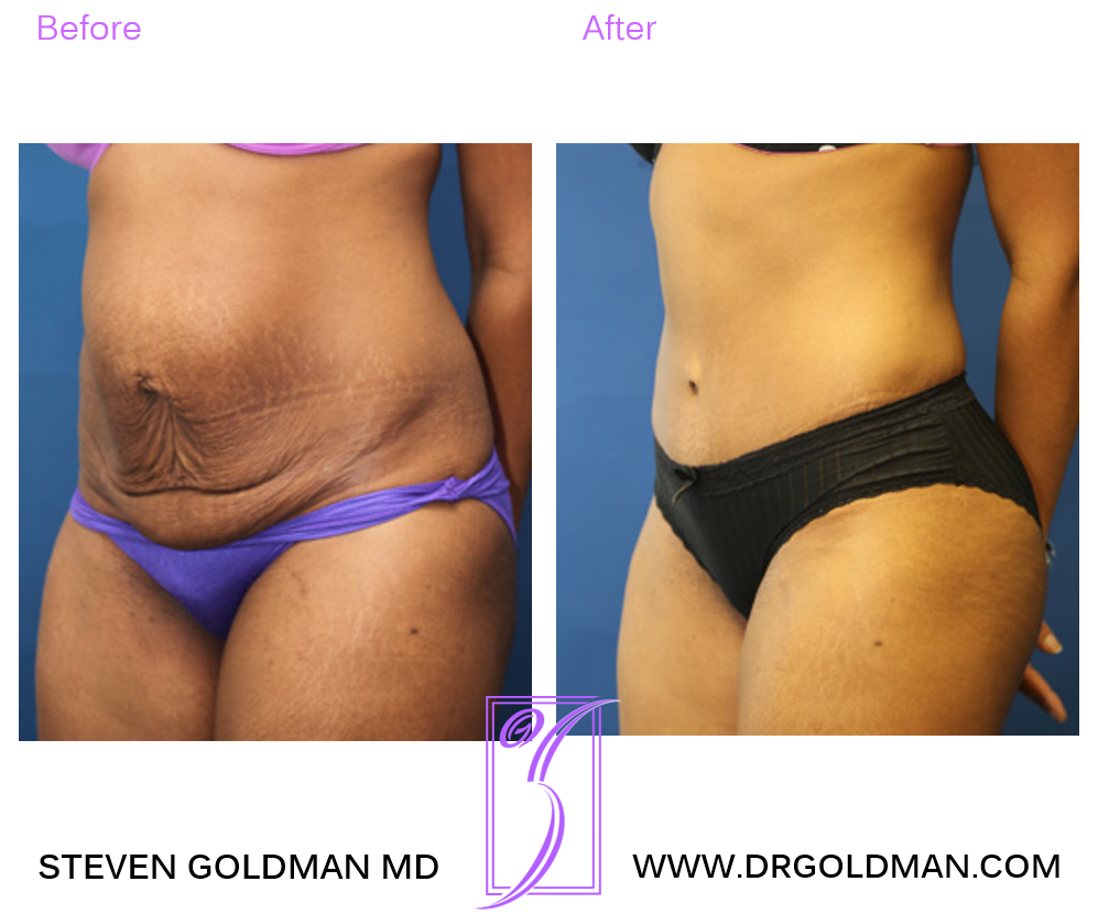 Abdominoplasty
