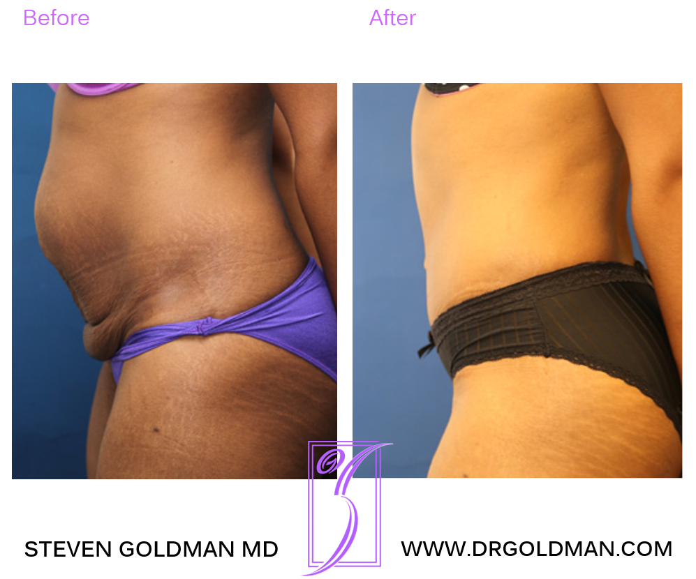 Abdominoplasty
