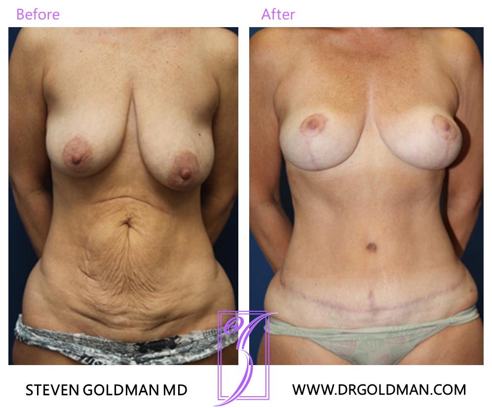 Breast Lift