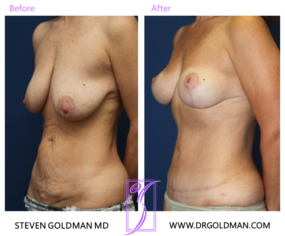 Breast Lift