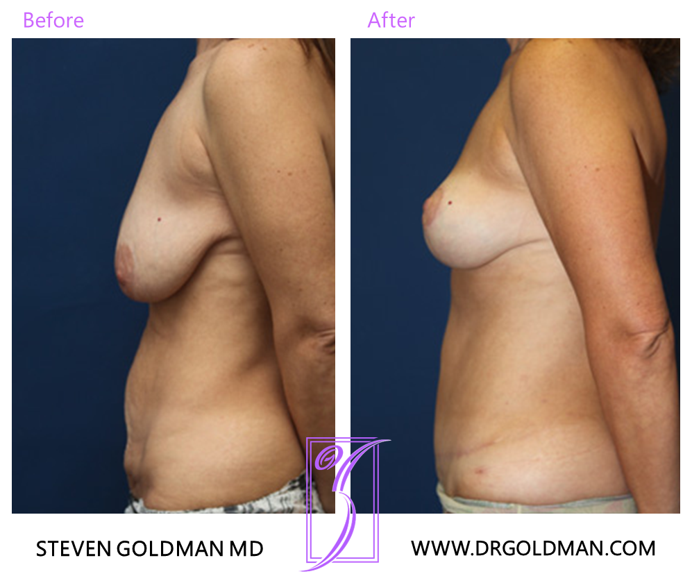 Breast Lift